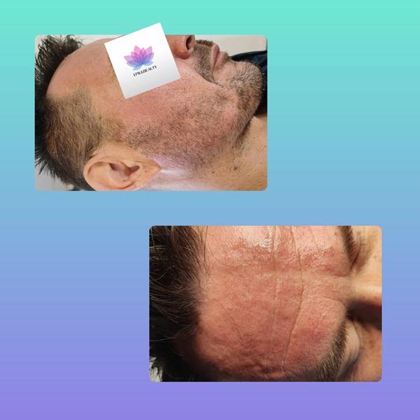 mezoterapia-mikroiglowa-1