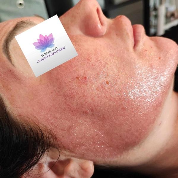mezoterapia-mikroiglowa-2