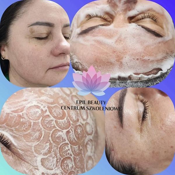 mezoterapia-mikroiglowa-3