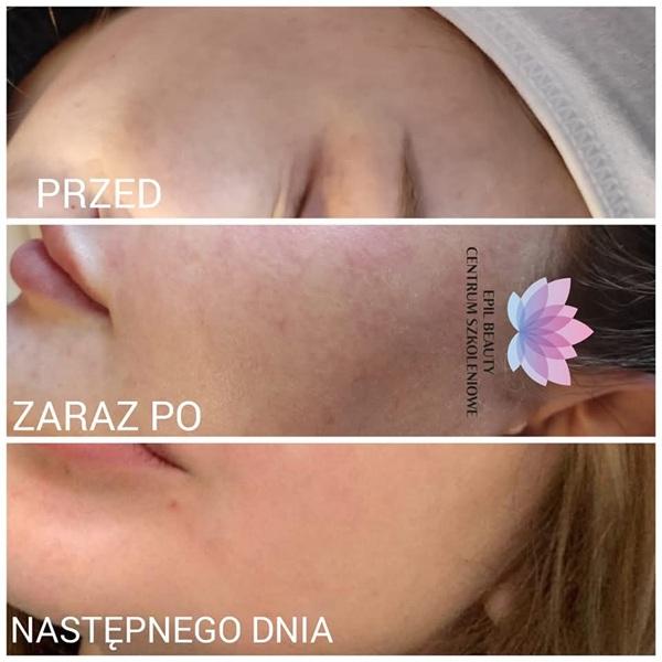 mezoterapia-mikroiglowa-6